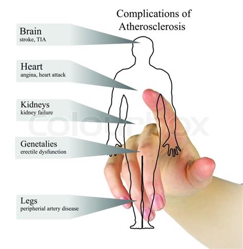 Complications of Atherosclerosis | Stock image | Colourbox