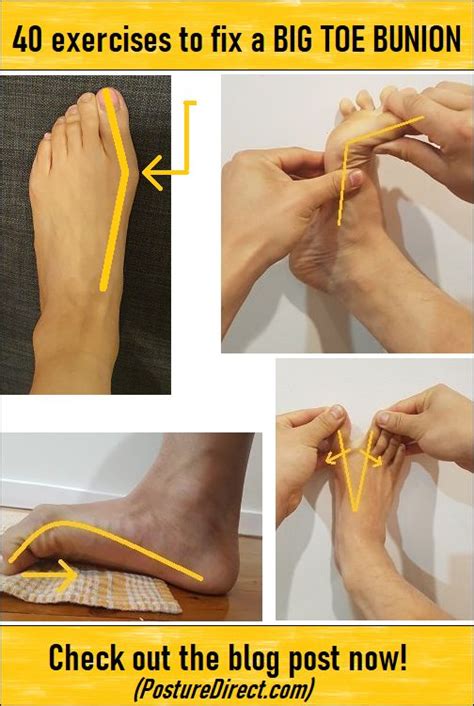 Big Toe Bunion Exercises in 2021 | Bunion exercises, Bunion remedies ...