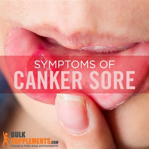 Canker Sore Under Tongue Web
