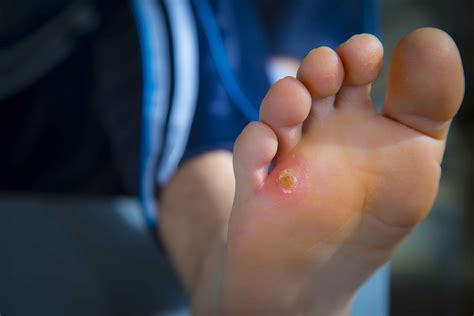 Corns and Calluses on the Feet - 4 Easy Ways on How to Prevent Them