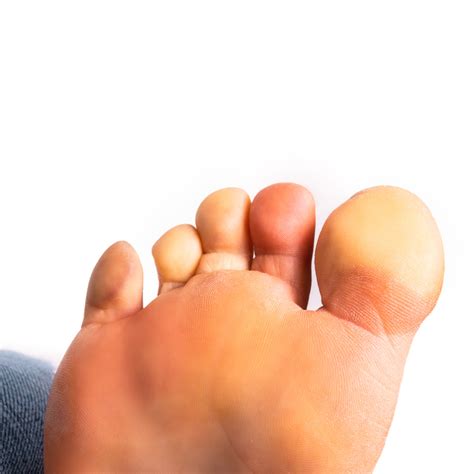 Facts about Raynaud’s — New York Foot Health | NYSPMA | New York State ...