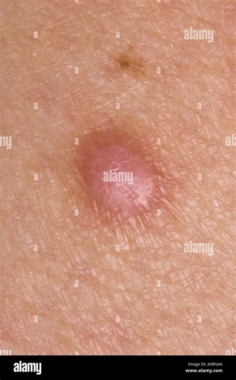 Dermatofibroma Stock Photo: 5482921 - Alamy