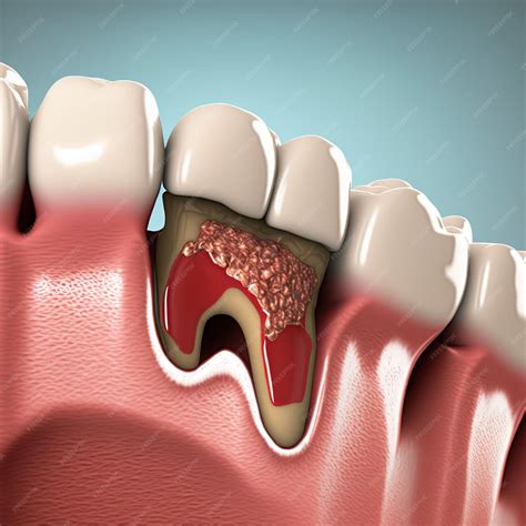 Premium Photo | Gums gum inflammation gingival recession Dental