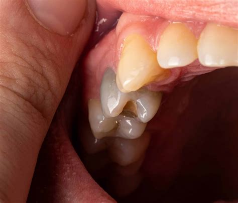 Black Teeth: Causes, Treatment, and Prevention