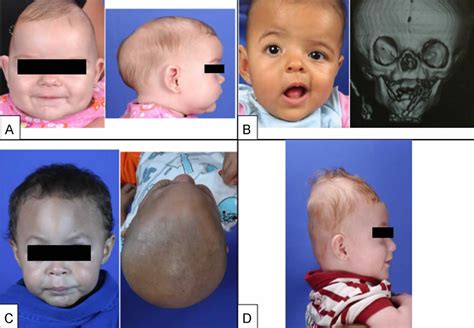 Craniosynostosis Syndrome