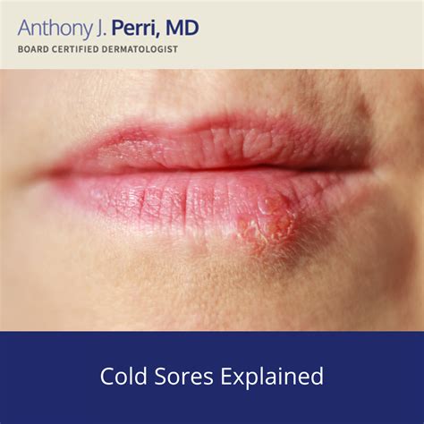 2 Essential Habits To Heal Cold Sores Faster