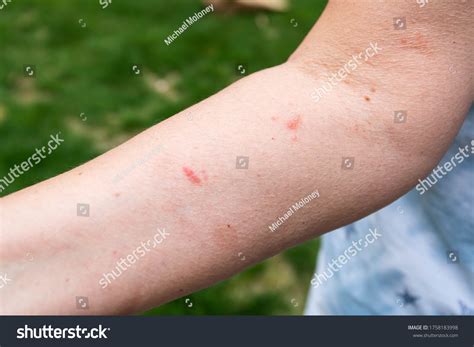 Poison Ivy Blisters Spread at Zoe Bastyan blog