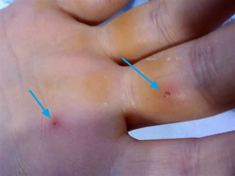 Osler nodes, Janeway lesions & splinter hemorrhages