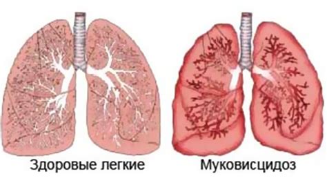 Муковисцидоз у детей: виды, причины возникновения, симптомы ...