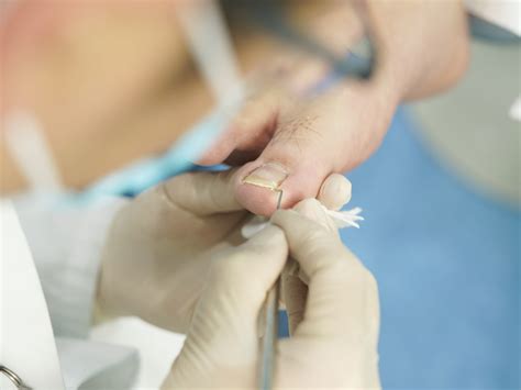 Laser Toenail Fungus Treatment | Podiatrists Housecalls Chicago