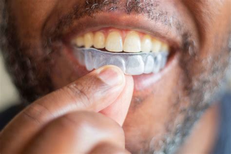 Advances and Trends in Cosmetic Dentistry - The Smile Design