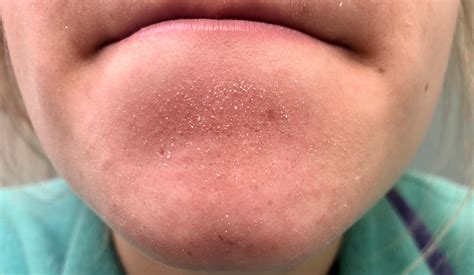 White Liquid Coming Out Of Hamster at Bennie Morris blog