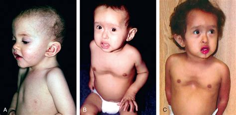 Pectus Excavatum and Pectus Carinatum - Clinical Tree