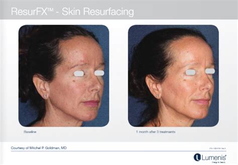 M22 Laser Treatments | M Medi Spa