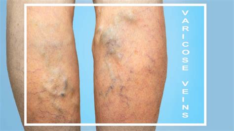varicose veins bodybuilding      avoid  fix