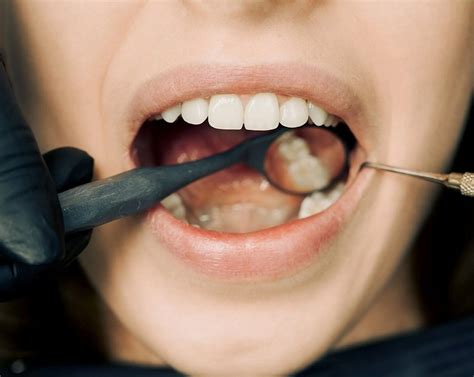 Are You Always Getting Food Stuck In Your Teeth? | Klinik Gigi Near Me