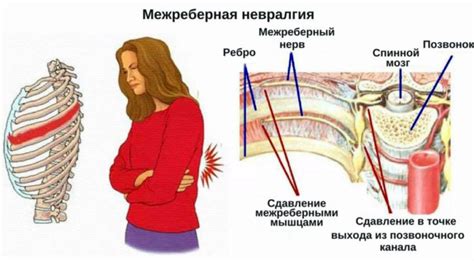 Межрёберная невралгия: причины, признаки, симптомы, лечение, осложнения ...
