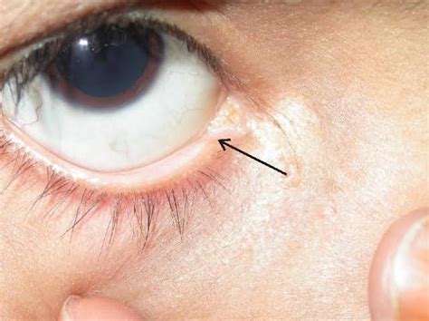 Pentingnya Lacrimal Punctum bagi Penglihatan Kita - Jenggala.id