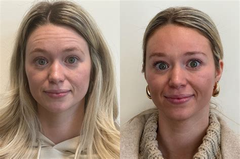 Botox® Treatments - Thrive Medical Spa