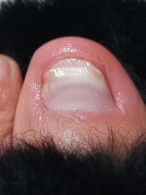3 months of terbinafine : r/NailFungus