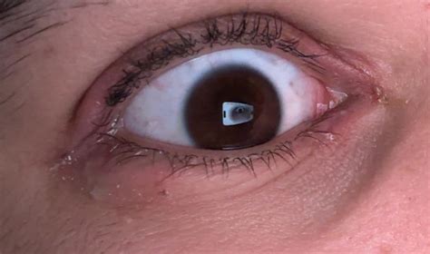 Eyelashes and eye burn : r/EyeCareTips