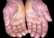 Occupational skin disorders – what are the common types? | C&C Consulting