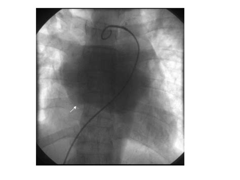 percutaneous mitral commissurotomy   case  mirror image