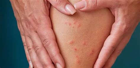 Como É A Picada De Pulga - Picaduras de pulgas: ¿Cómo identificarlas y tratarlas?