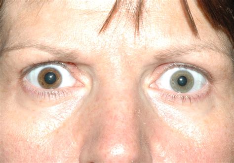 Heterochromia | CMAJ