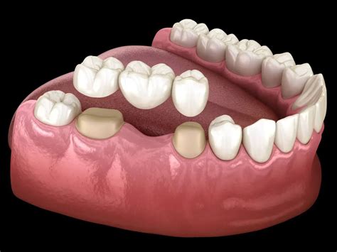 porcelain dental bridge pineview dental health