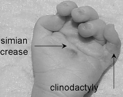 clinodactyly hand orthobullets