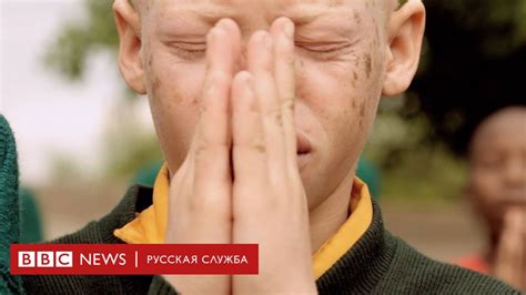 Альбинос в Африке - BBC News Русская служба