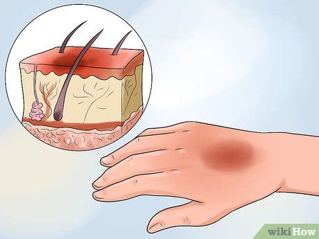 Как лечить ожоги (с иллюстрациями) - wikiHow