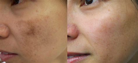 Best PIH post inflammatory hyperpigmentation treatments