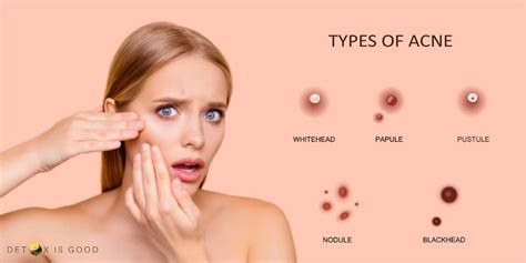 How to Get Rid of Closed Comedones? (+ Natural Remedies)