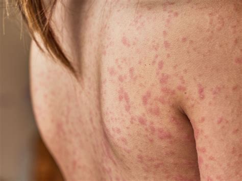 Rash On Neck At Hairline