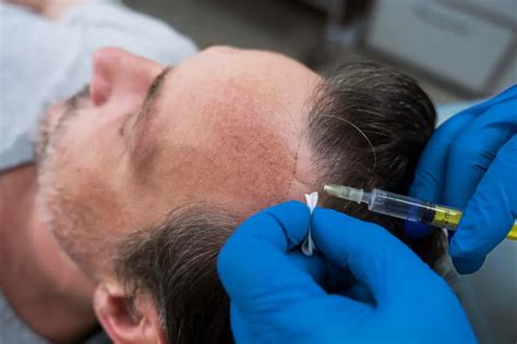 PRP Therapy vs. Hair Transplants: When Should You Choose PRP?