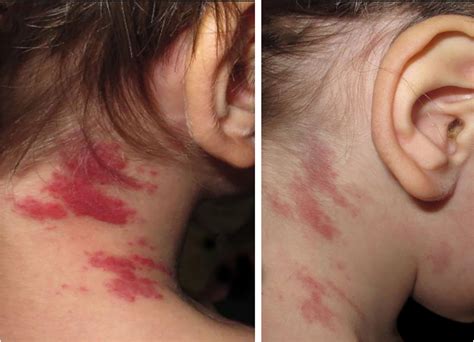 Hemangioendotelioma kaposiforme e angioma em tufos: duas entidades do ...