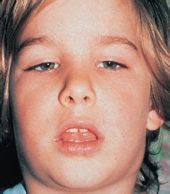 Enlarged Adenoids Adenoid Facies Youtube - vrogue.co