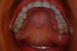 swollen roof  mouth   treatment