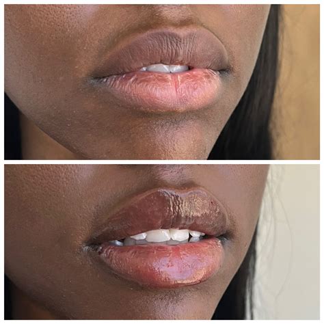 Lipstick After Lip Injections at Loren Griffith blog