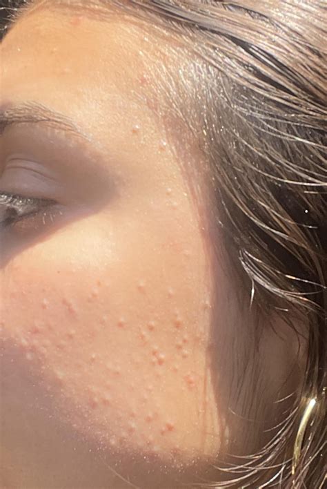 does this look like fungal acne? : r/Fungalacne