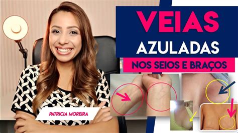 Como Ficam As Veias No Inicio Da Gravidez - VEIAS APARENTES SINAL DE GRAVIDEZ? | Patrícia Moreira - YouTube