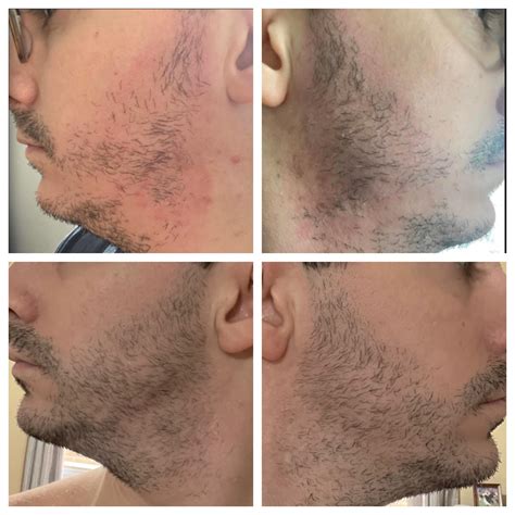 Slow Gainer... 13 months : r/Minoxbeards