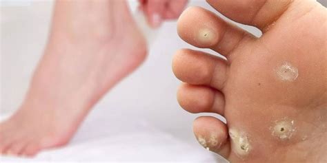 Лечение стержневой мозоли