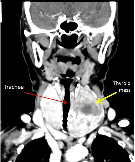 Anaplastic thyroid carcinoma – Radiology Cases