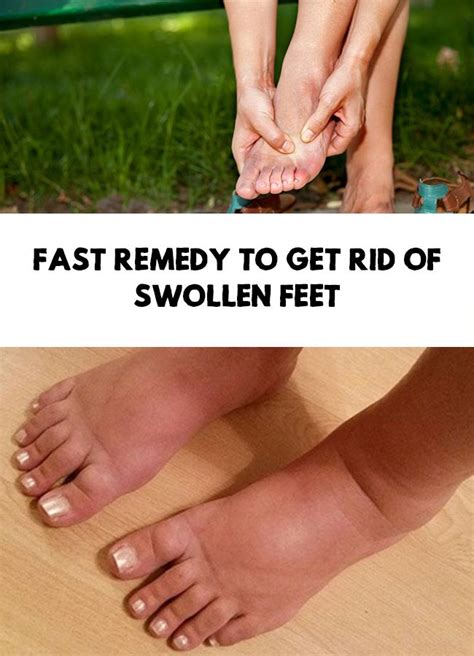 Fast remedy to get rid of swollen feet | Swelling feet remedies ...