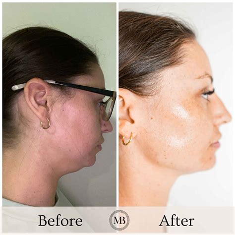 Double Chin Fat Dissolver - La Belle Clinic