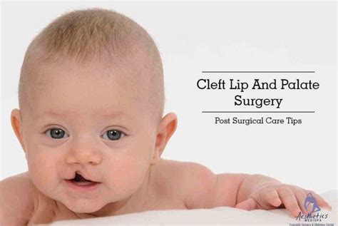 Cleft Lip And Palate Surgery - Post Surgical Care Tips