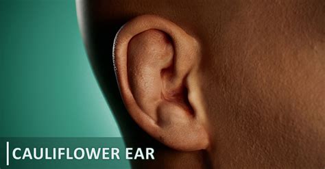 Cauliflower Ear How Does It Happen at William McKoy blog